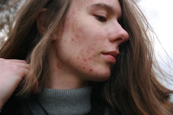 Kan man behandle Rosacea?