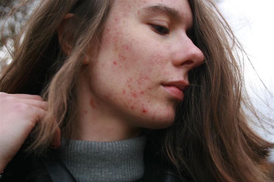 Kan man behandle Rosacea?
